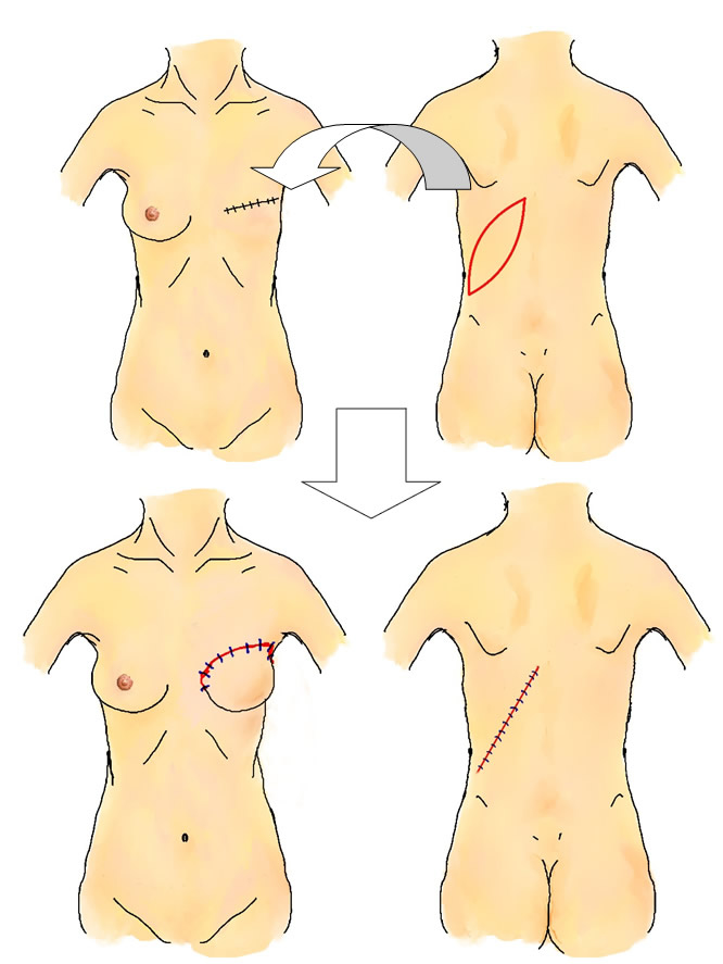 乳房再建について 大和市立病院