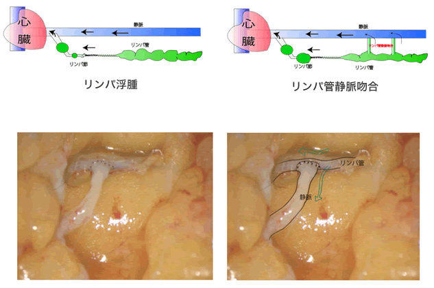 リンパ浮腫の治療 大和市立病院