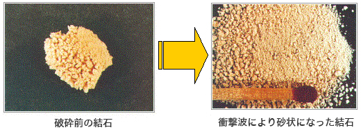 結石破砕室で行われる検査 エックス線診療室6 大和市立病院 結石破砕室で行われる検査 エックス線診療室6 大和市立病院